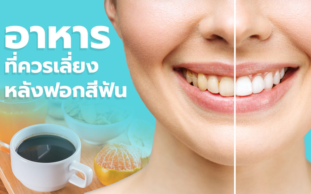 อาหารที่ควรเลี่ยงหลังฟอกสีฟัน