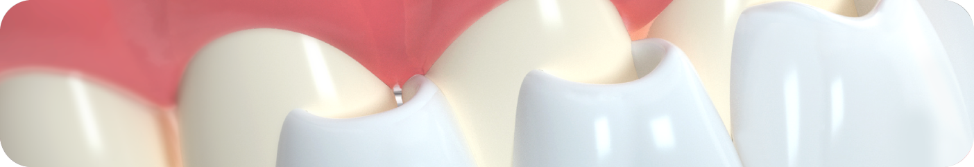 veneer2